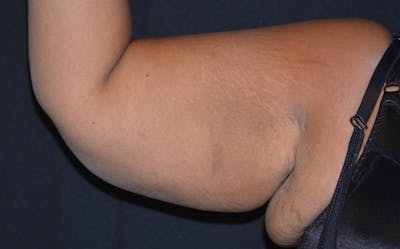 CoolSculpting Before & After Gallery - Patient 195483 - Image 1