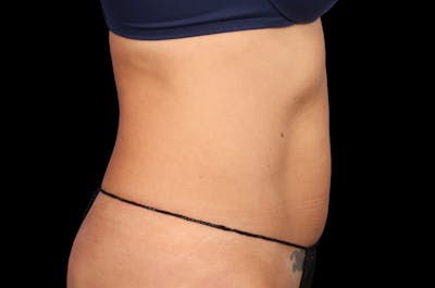 EmSculpt Before & After Gallery - Patient 133591 - Image 2