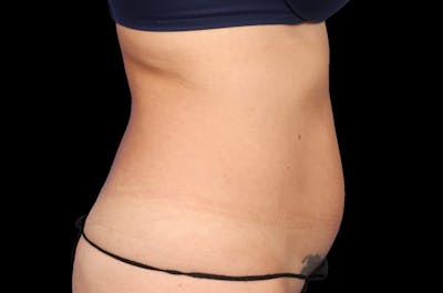 EmSculpt Before & After Gallery - Patient 133591 - Image 1