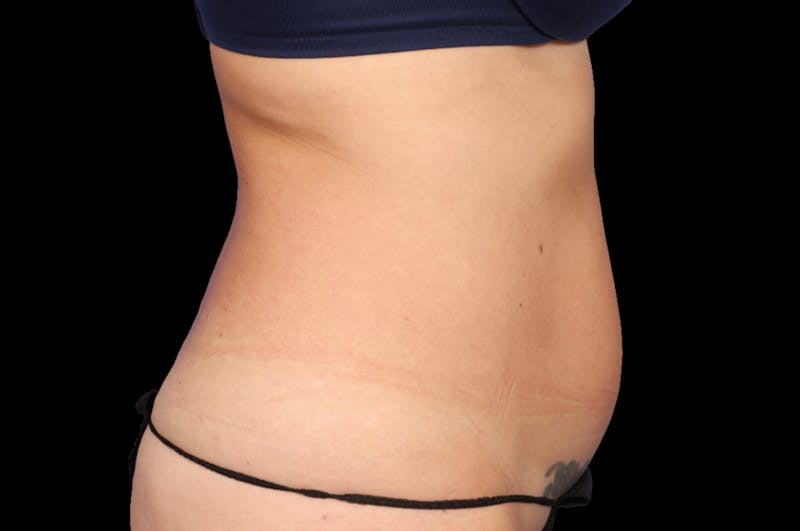 EmSculpt Before & After Gallery - Patient 133591 - Image 1