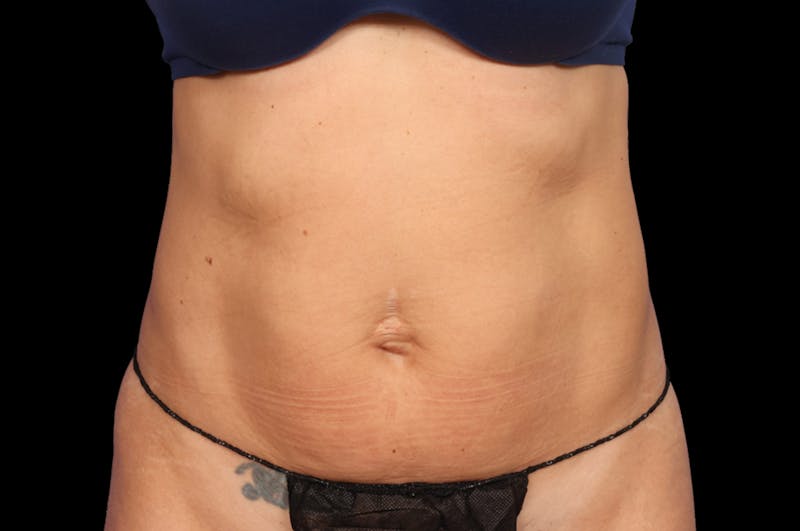 EmSculpt Before & After Gallery - Patient 133591 - Image 4