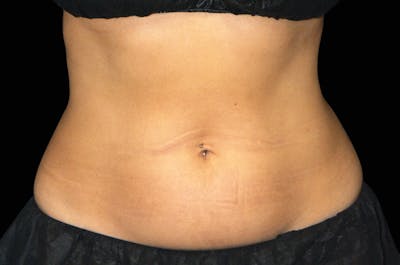 EmSculpt Before & After Gallery - Patient 242931 - Image 1