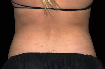Emsculpt Neo Pic of Treatment Areas