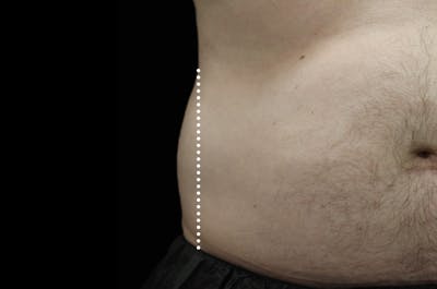 Emsculpt Neo Pic of Treatment Areas
