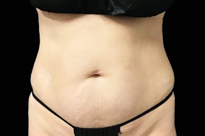 EmSculpt Before & After Gallery - Patient 171969 - Image 2