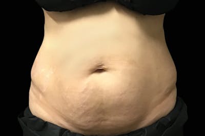EmSculpt Before & After Gallery - Patient 171969 - Image 1