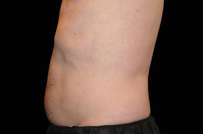 EmSculpt Before & After Gallery - Patient 227498 - Image 1