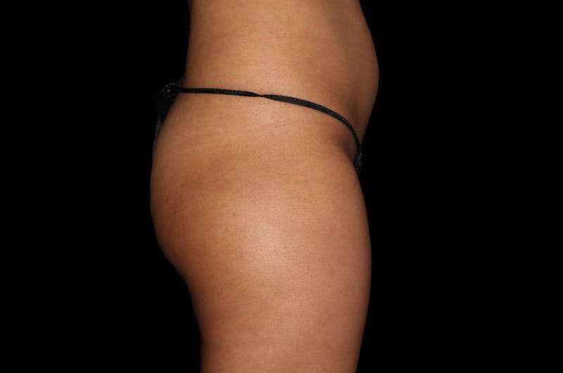 Emsculpt Neo Pic of Treatment Areas