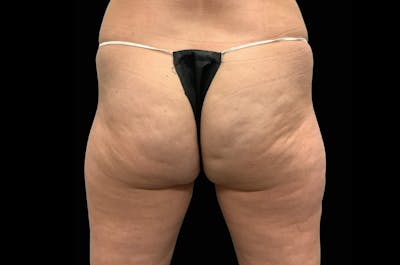 EmSculpt Before & After Gallery - Patient 342557 - Image 1