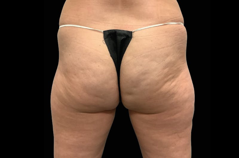 EmSculpt Before & After Gallery - Patient 342557 - Image 1