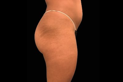 EmSculpt Before & After Gallery - Patient 938751 - Image 2