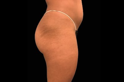 EmSculpt Before & After Gallery - Patient 938751 - Image 2