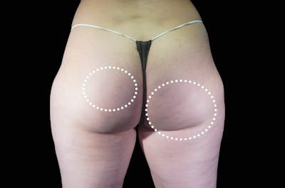 EmSculpt Before & After Gallery - Patient 325767 - Image 2