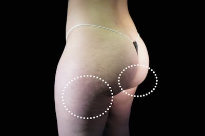 EmSculpt Before & After Gallery - Patient 236562 - Image 2