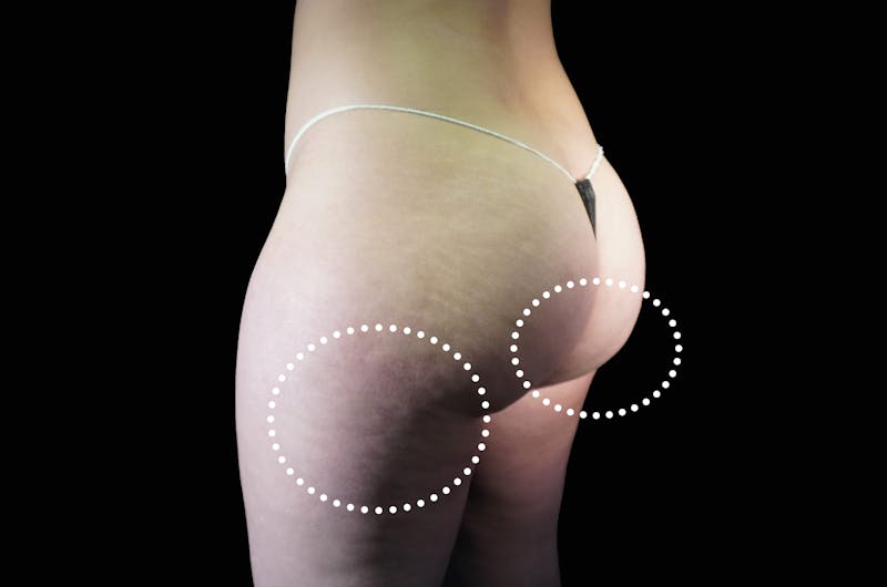 EmSculpt Before & After Gallery - Patient 236562 - Image 2