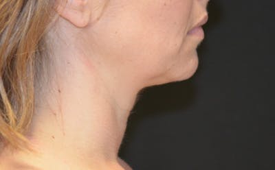 there is a woman with a neck brace and a black background
