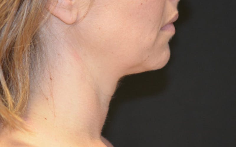 there is a woman with a neck brace and a black background