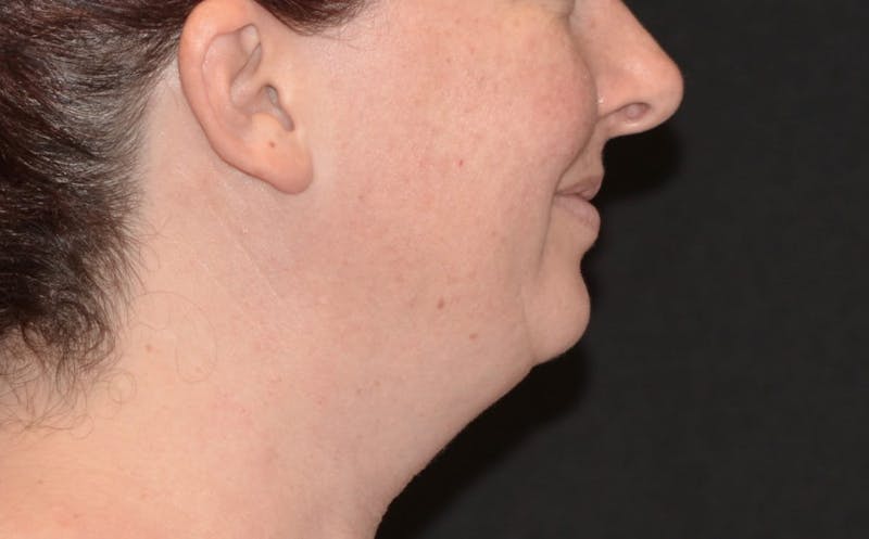 a close up of a woman with a very small amount of wrinkles