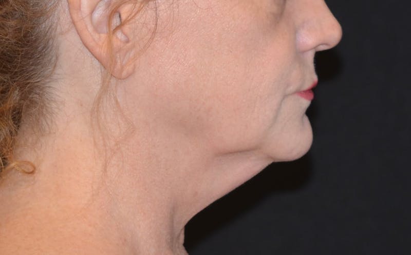 a close up of a woman with a neck lift before and after surgery