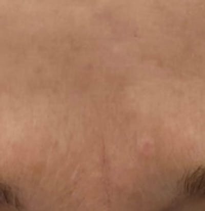 a close up of a person's forehead