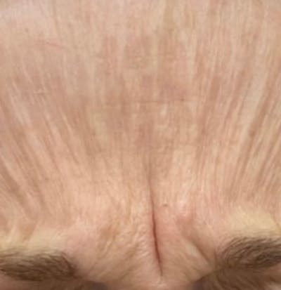 a close up of a person's forehead