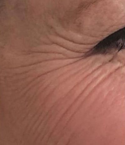 a close up of a woman's eye with wrinkles