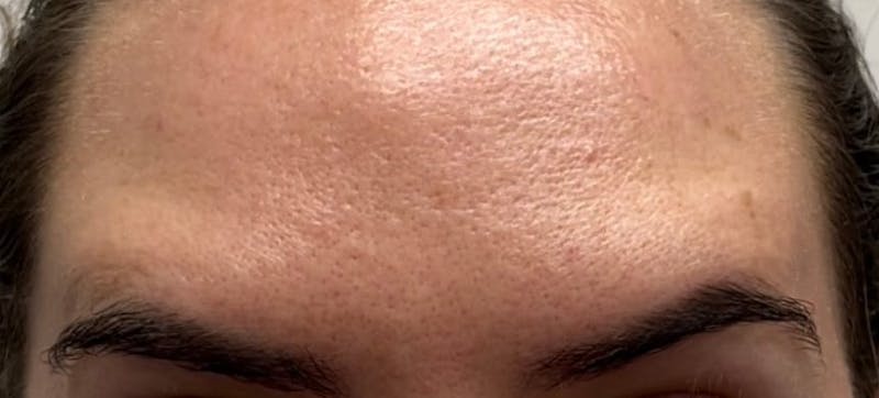 a close up of a person's forehead