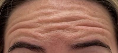 a close up of a woman with wrinkles on her forehead