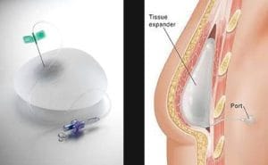 tissue expanders