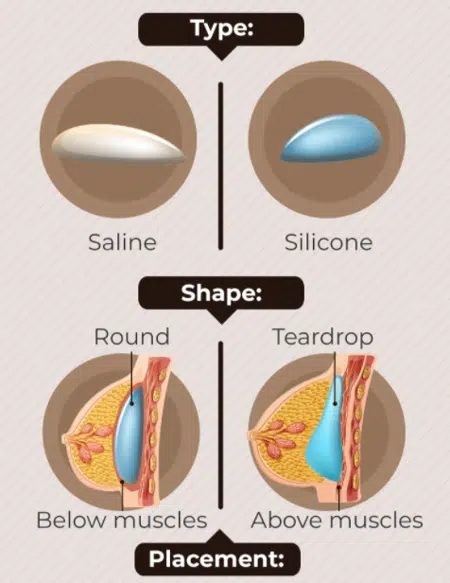 breast implant infographic