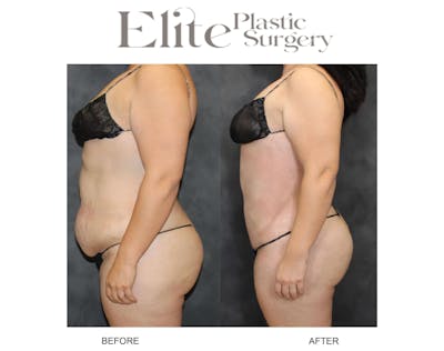 Abdominoplasty (Tummy Tuck) Before & After Gallery - Patient 155689 - Image 1