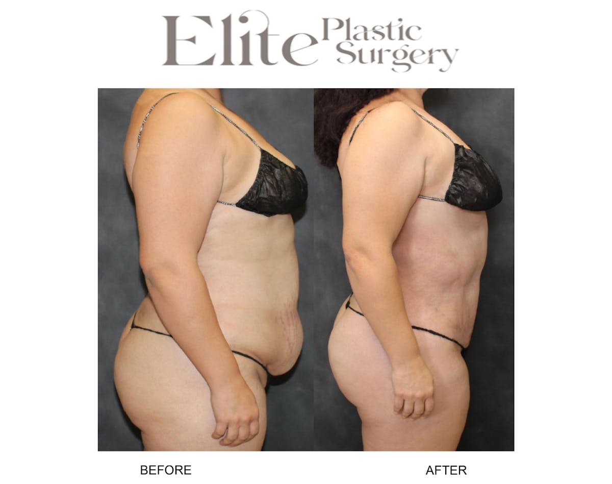 Abdominoplasty (Tummy Tuck) Before & After Gallery - Patient 155689 - Image 2