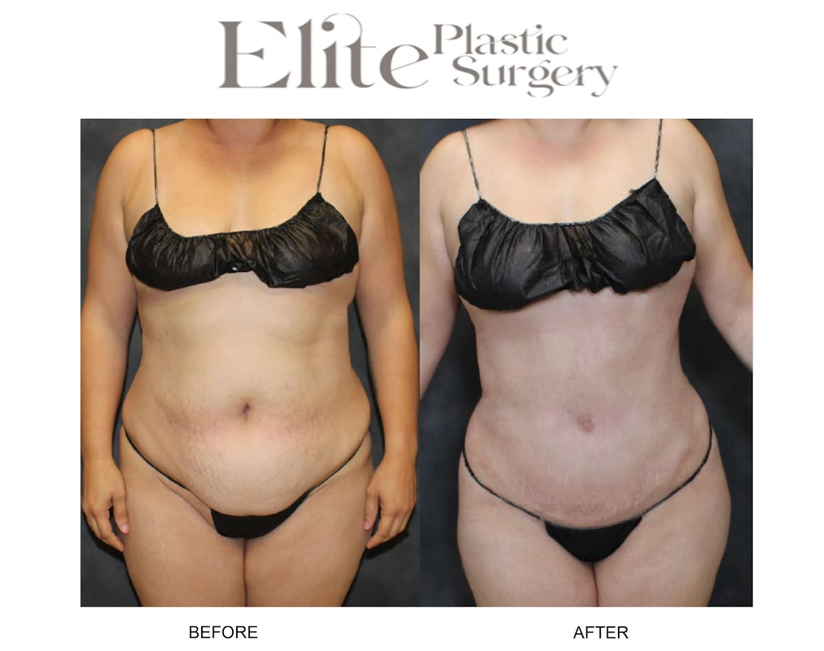 Abdominoplasty (Tummy Tuck) Before & After Gallery - Patient 155689 - Image 3