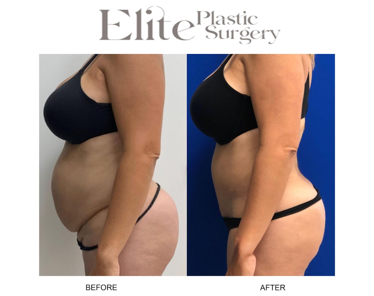Abdominoplasty (Tummy Tuck) Before & After Gallery - Patient 153686 - Image 1