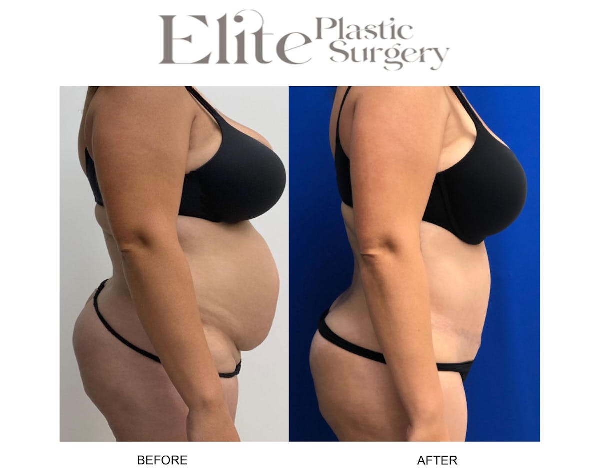 Abdominoplasty (Tummy Tuck) Before & After Gallery - Patient 153686 - Image 2
