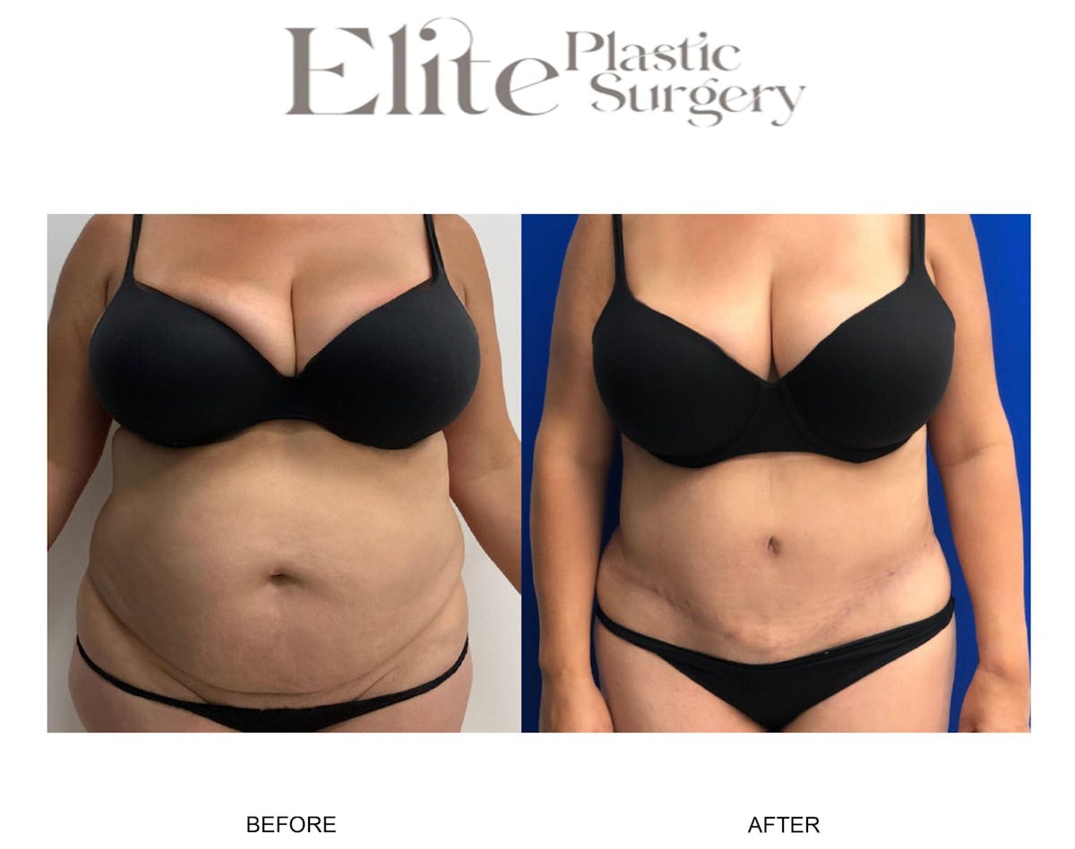 Abdominoplasty (Tummy Tuck) Before & After Gallery - Patient 153686 - Image 3