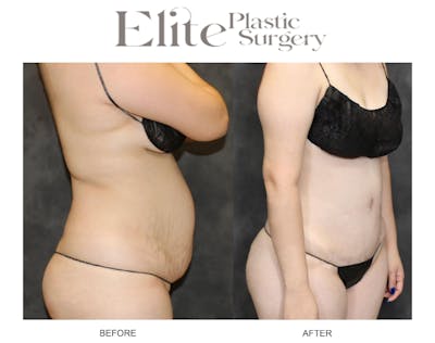 Abdominoplasty (Tummy Tuck) Before & After Gallery - Patient 712644 - Image 1