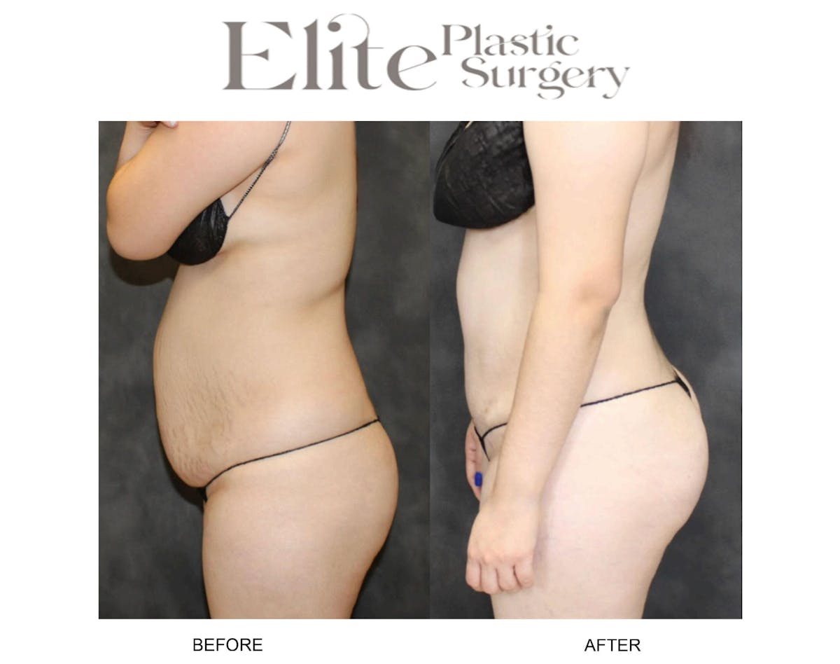 Abdominoplasty (Tummy Tuck) Before & After Gallery - Patient 712644 - Image 2