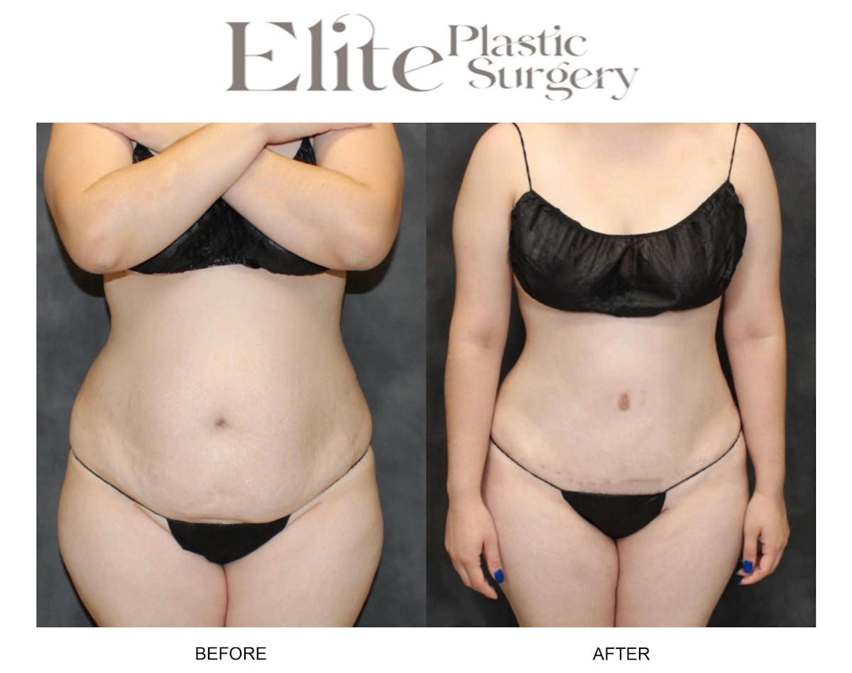 Abdominoplasty (Tummy Tuck) Before & After Gallery - Patient 712644 - Image 3