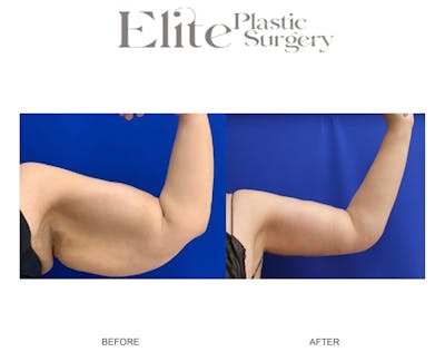 Brachioplasty (Arm Reduction) Before & After Gallery - Patient 305609 - Image 1