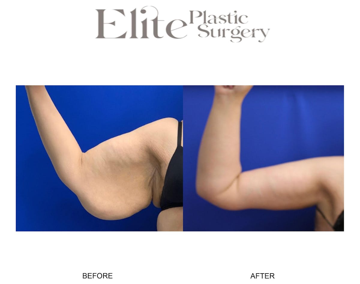 Brachioplasty (Arm Reduction) Before & After Gallery - Patient 305609 - Image 2