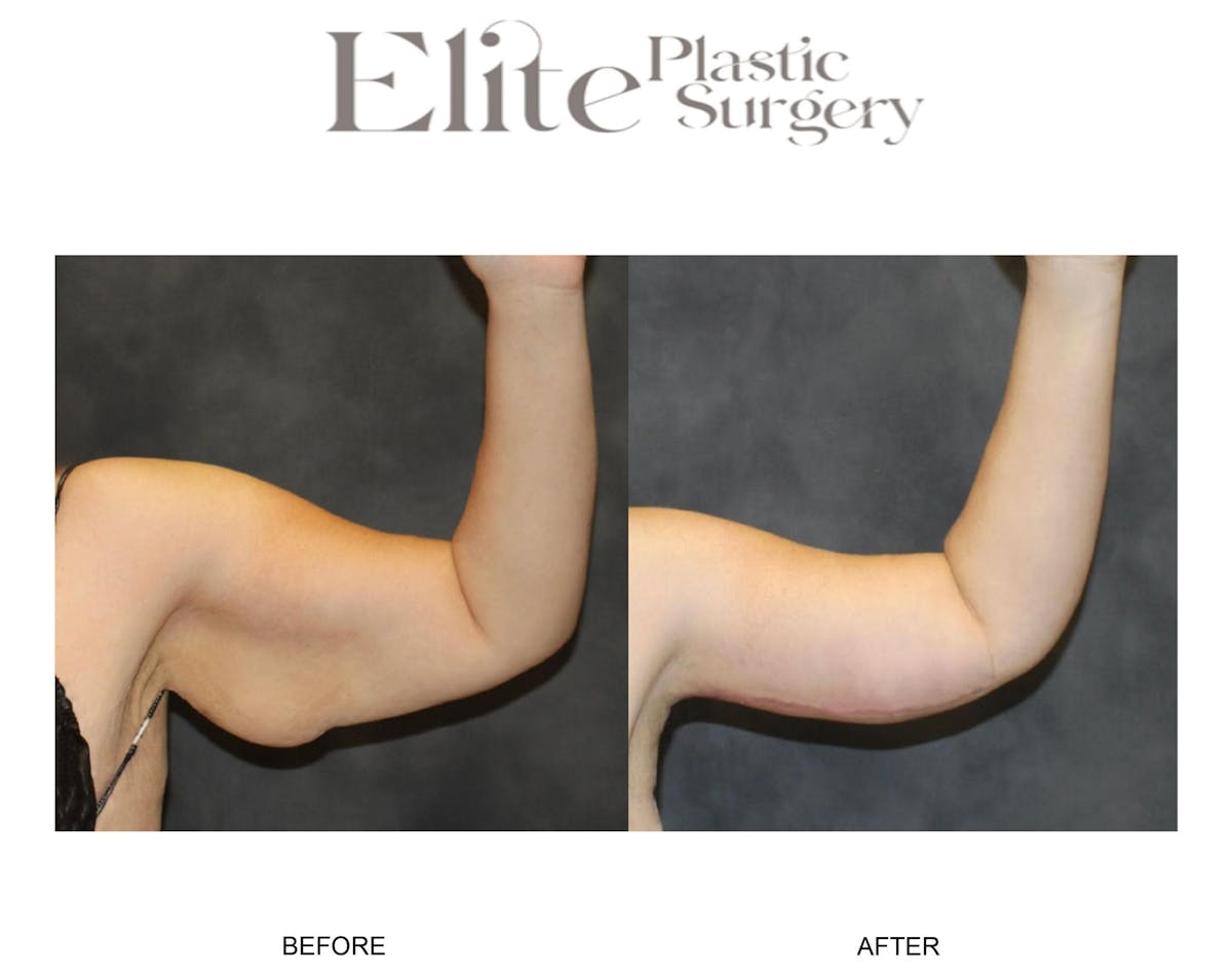 Brachioplasty (Arm Reduction) Before & After Gallery - Patient 406101 - Image 2