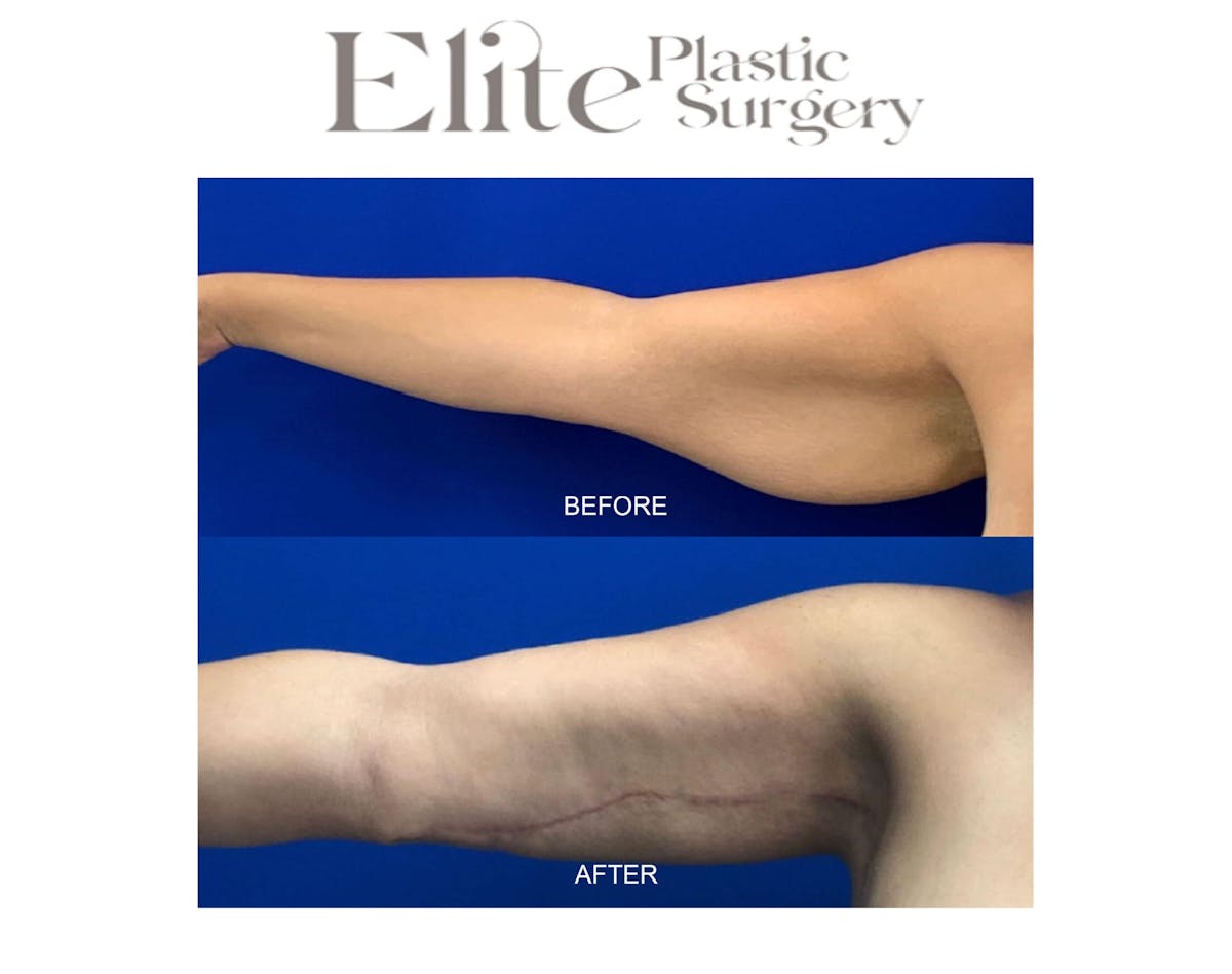 Brachioplasty (Arm Reduction) Before & After Gallery - Patient 146502 - Image 1