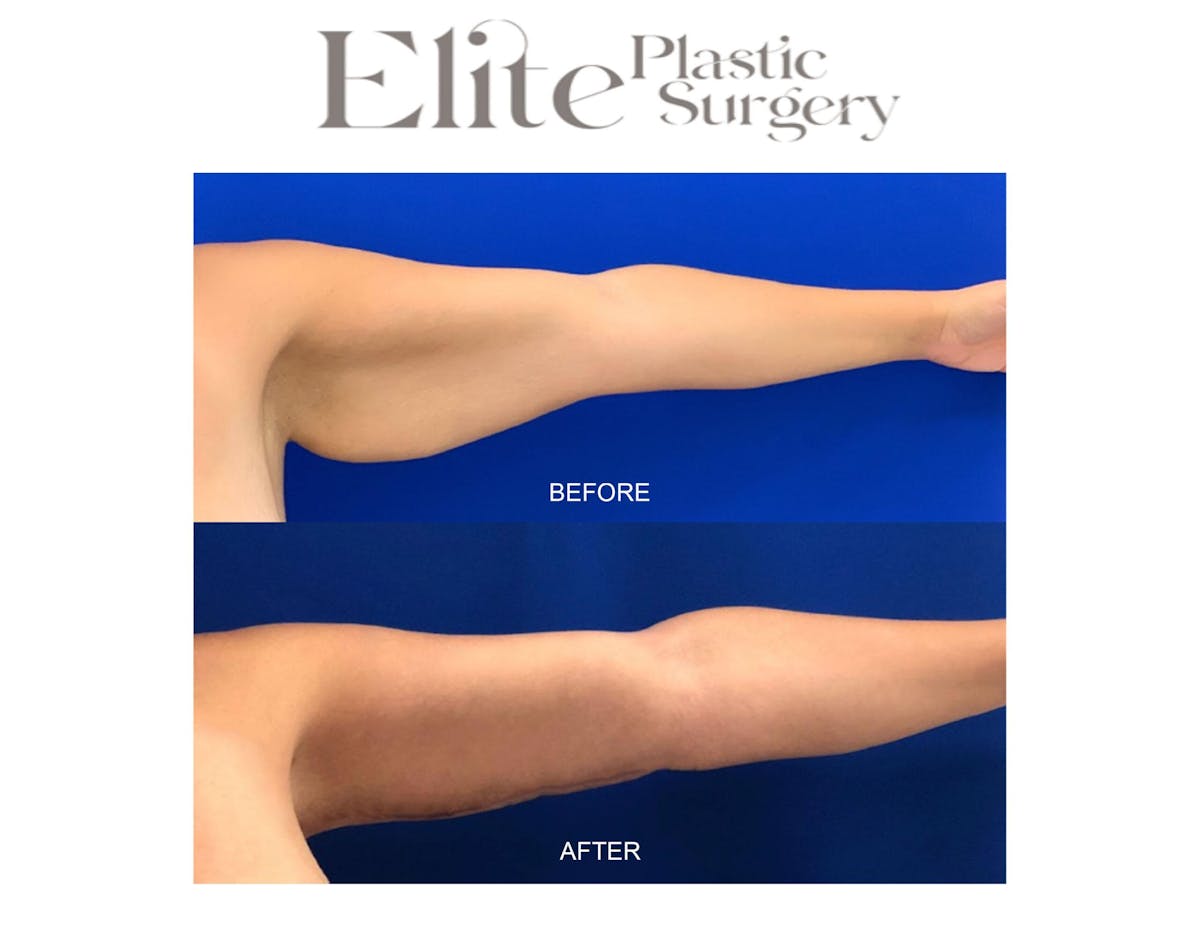 Brachioplasty (Arm Reduction) Before & After Gallery - Patient 146502 - Image 2