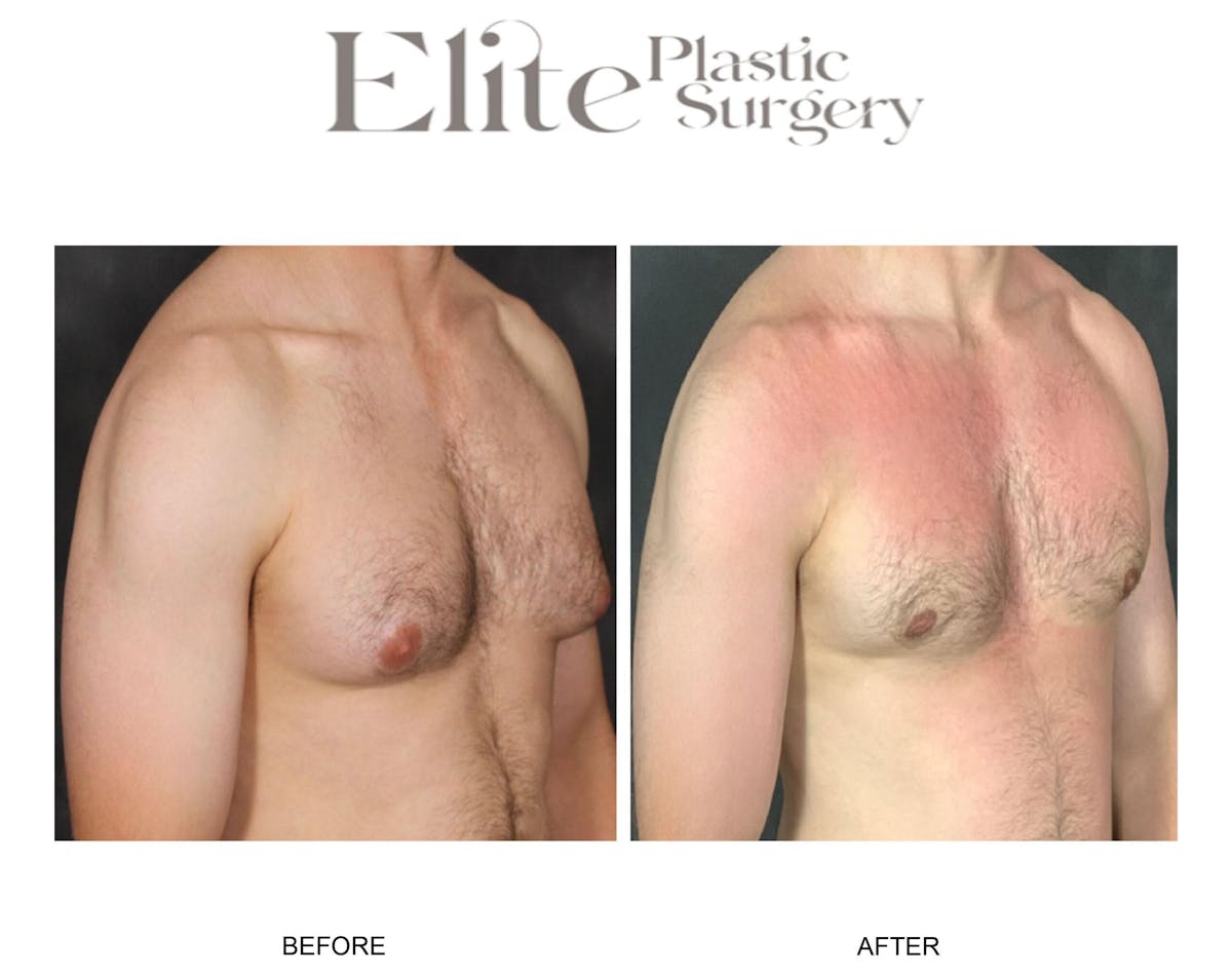 Male Gynecomastia Before & After Gallery - Patient 192814 - Image 2
