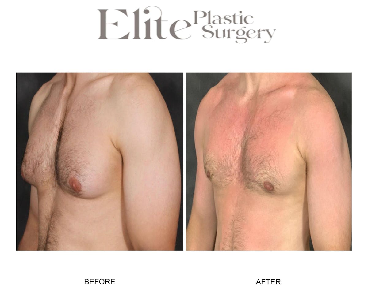 Male Gynecomastia Before & After Gallery - Patient 192814 - Image 3