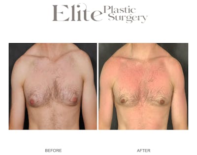 Male Gynecomastia Before & After Gallery - Patient 192814 - Image 1