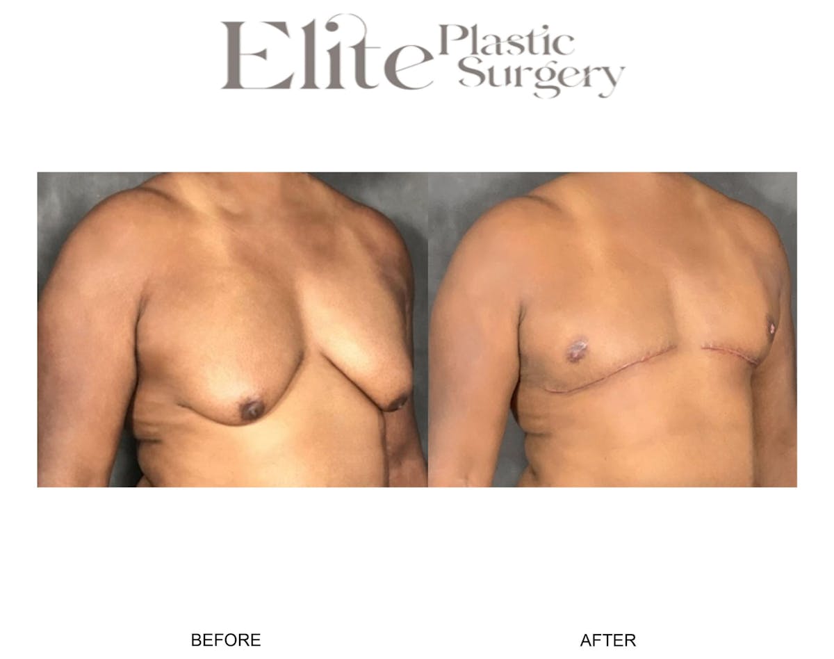 Male Gynecomastia Before & After Gallery - Patient 126420 - Image 2