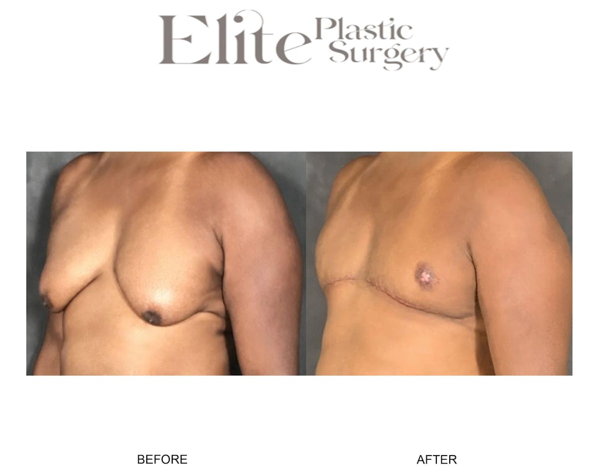 Male Gynecomastia Before & After Gallery - Patient 126420 - Image 3