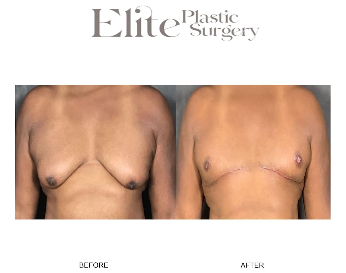 Male Gynecomastia Before & After Gallery - Patient 126420 - Image 1